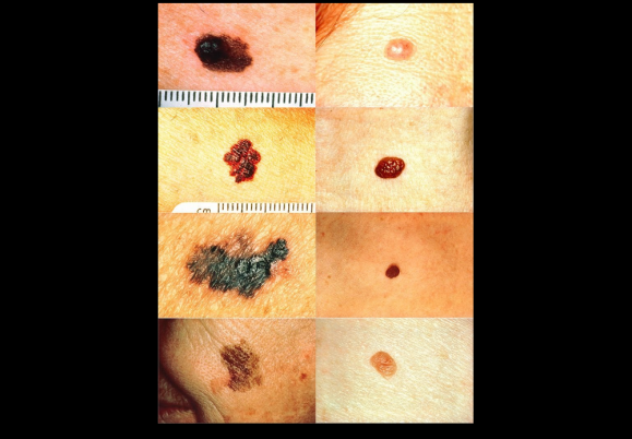 How to check a mole on your skin for cancer